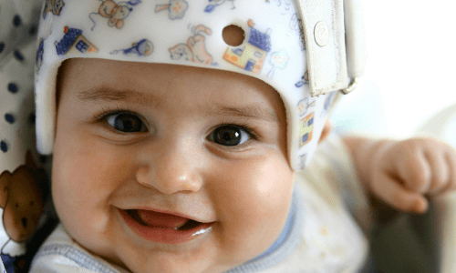 Baby smiling wearing special helmet to help with torticollis
